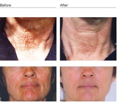 treatment to redness skin reduce Ionzyme Environ Elgin Salon at KAM Facials